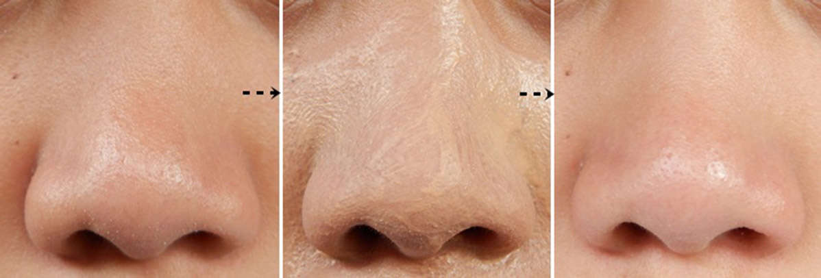 علاج مسامات واسعة في الوجه Revitol