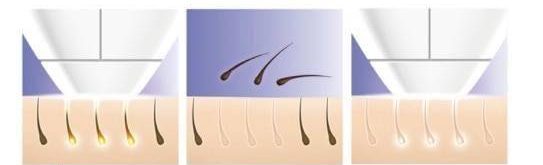 نتائج العلاج بالليزر لازالة الشعر في المنزل